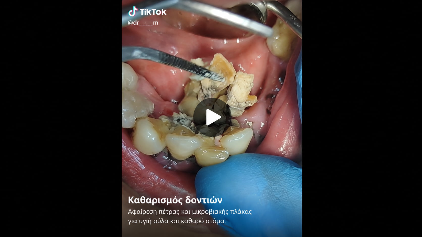 Αφαίρεση μεγάλης ποσότητας πέτρας κατά τον καθαρισμό δοντιών