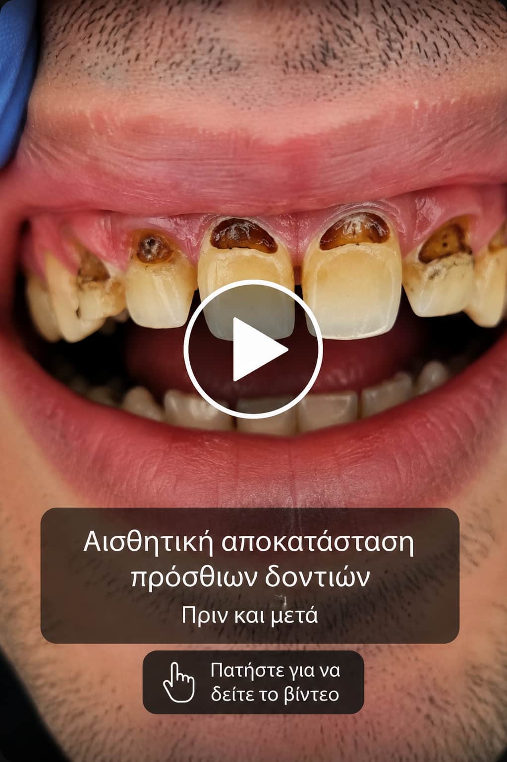 Αισθητική αποκατάσταση πρόσθιων δοντιών πριν και μετά